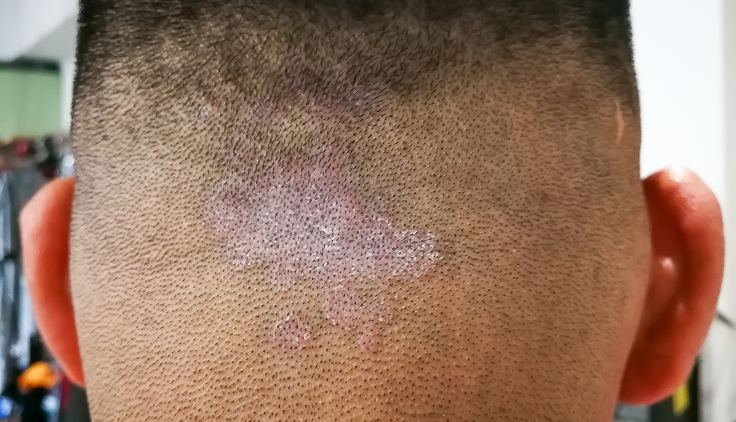 cuero cabelludo de un hombre con tiña