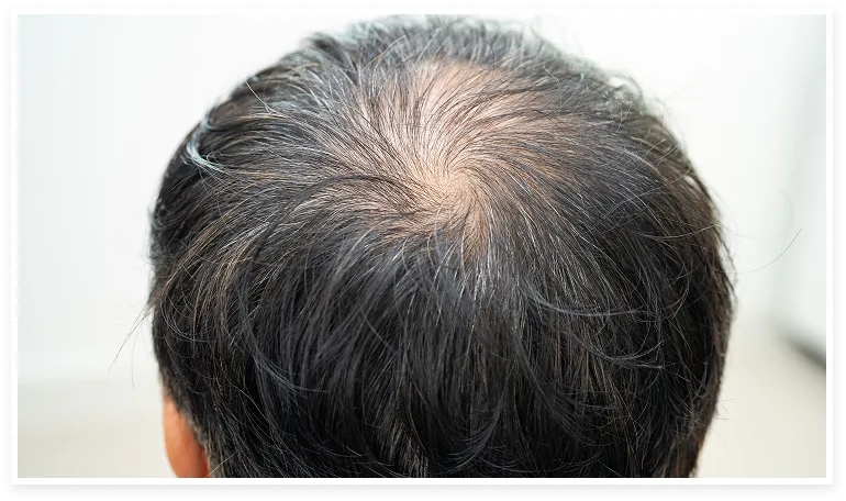 mujer u hombre con signos de alopecia